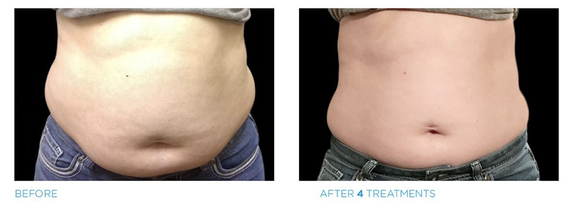 BTL Before and After