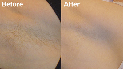 Before After Laser 1