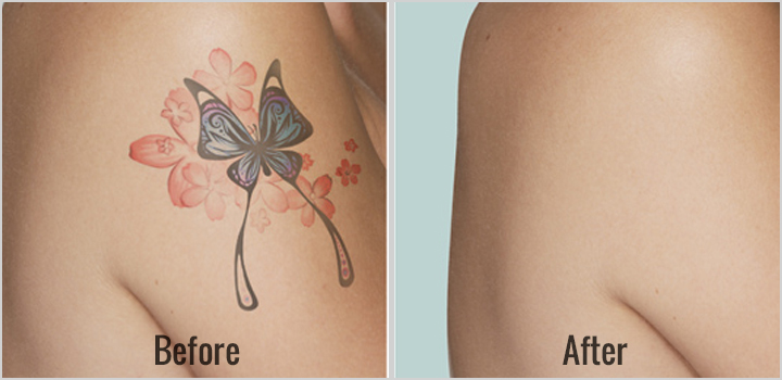 Before After Tattoo Removal 1