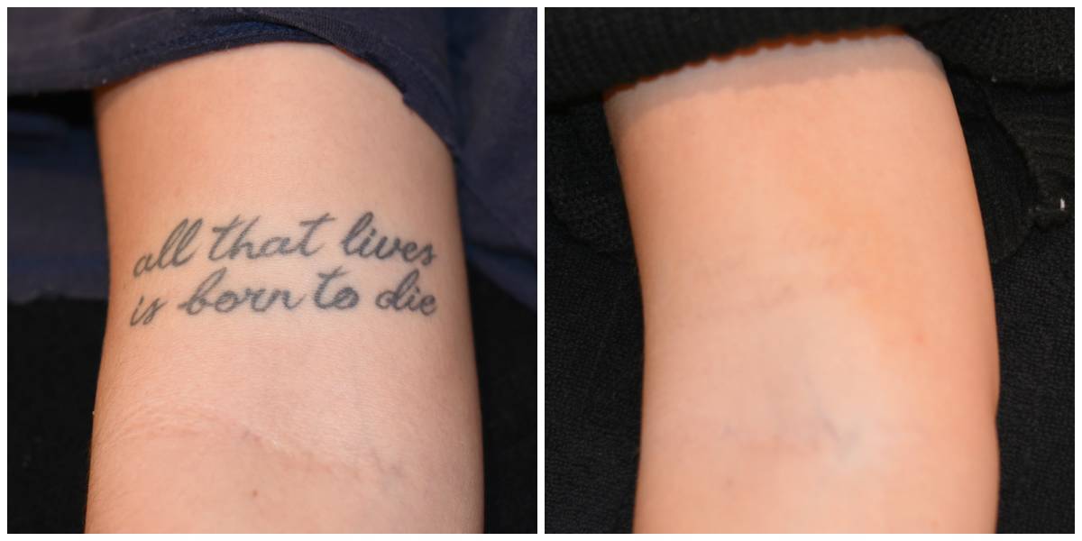 Before After Tattoo Removal 2